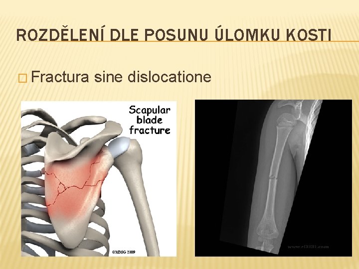 ROZDĚLENÍ DLE POSUNU ÚLOMKU KOSTI � Fractura sine dislocatione 