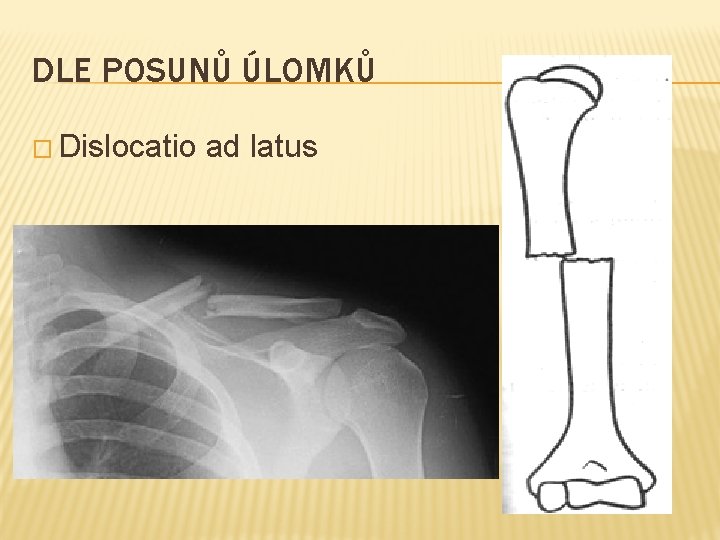 DLE POSUNŮ ÚLOMKŮ � Dislocatio ad latus 