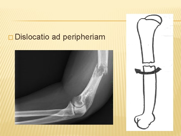 � Dislocatio ad peripheriam 