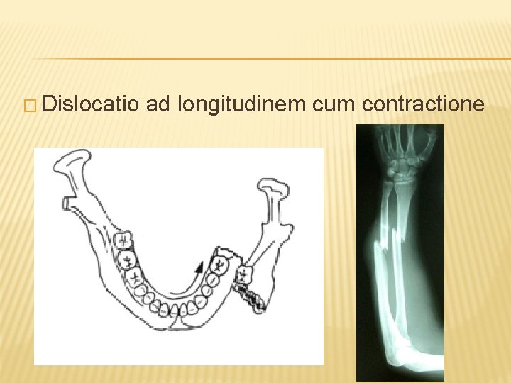 � Dislocatio ad longitudinem cum contractione 