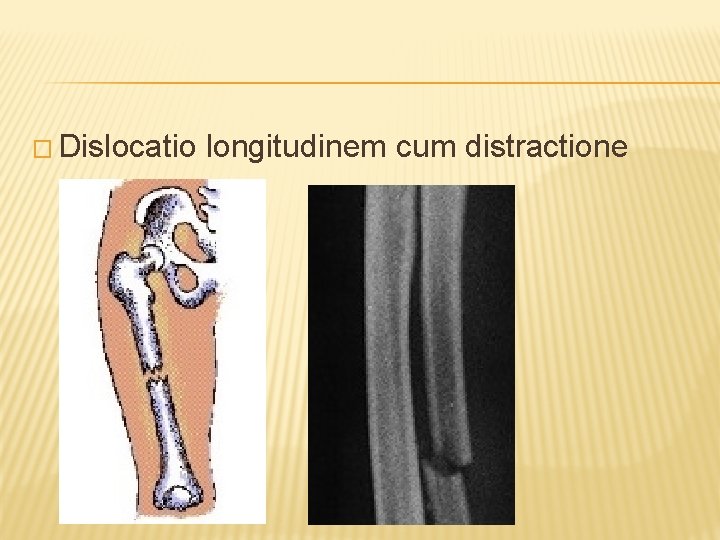 � Dislocatio longitudinem cum distractione 