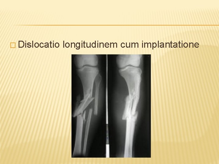 � Dislocatio longitudinem cum implantatione 