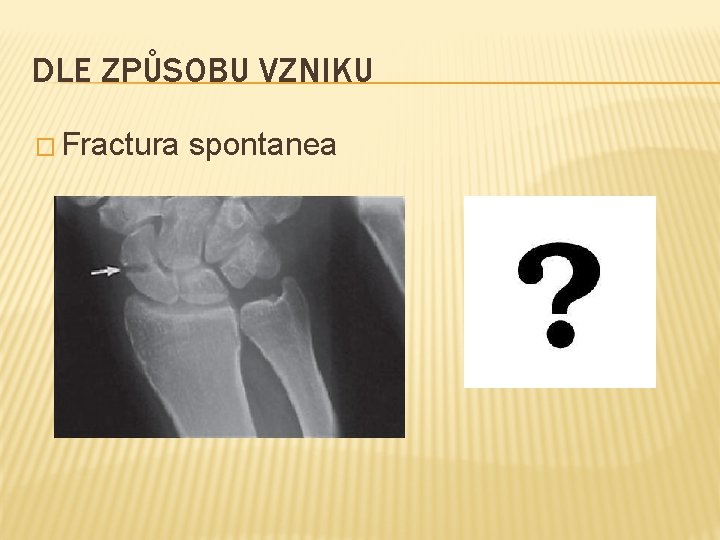 DLE ZPŮSOBU VZNIKU � Fractura spontanea 