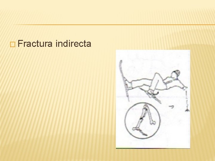 � Fractura indirecta 