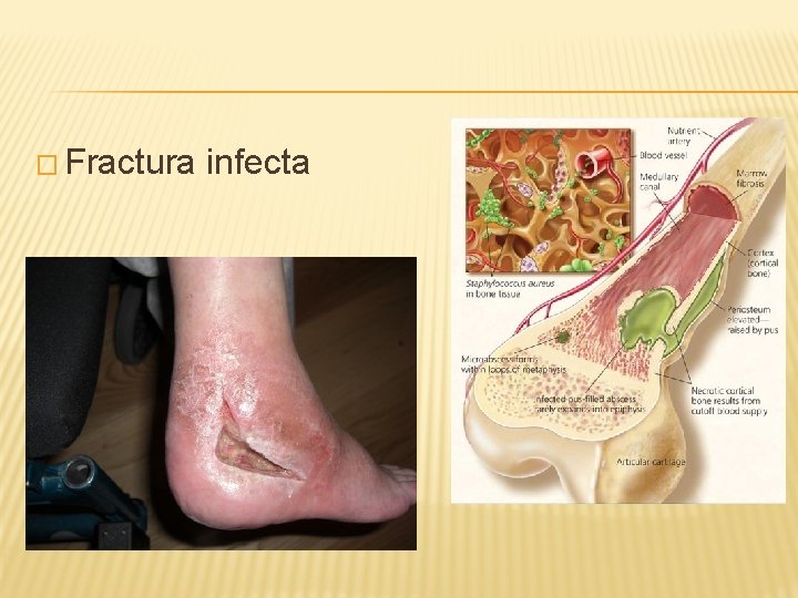 � Fractura infecta 