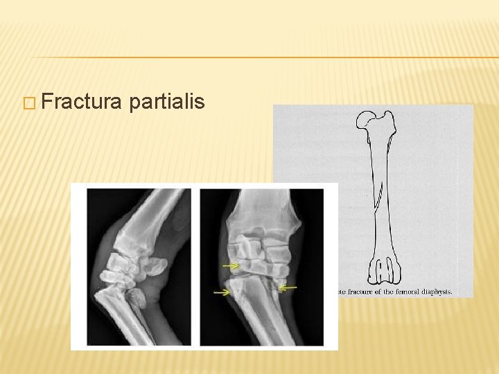 � Fractura partialis 