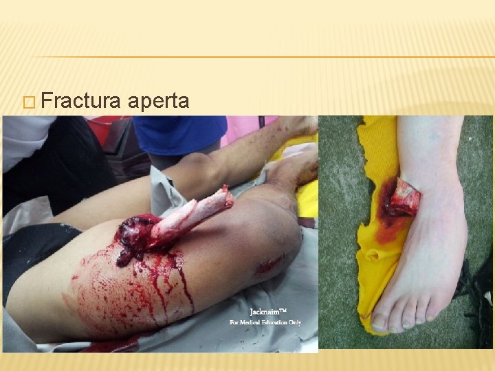 � Fractura aperta 
