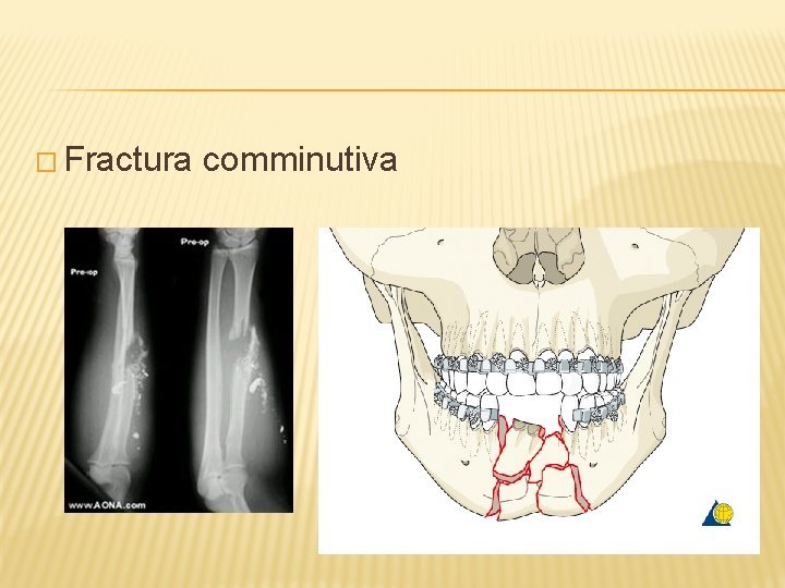 � Fractura comminutiva 