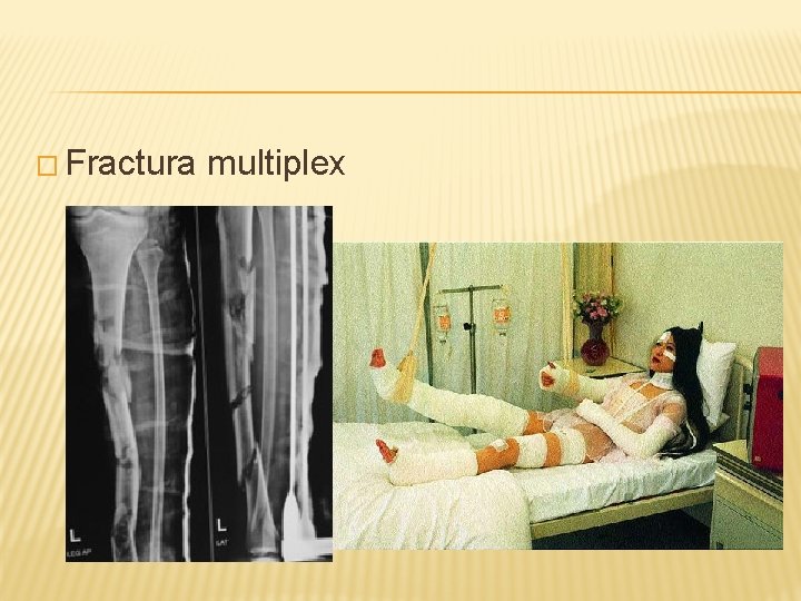 � Fractura multiplex 