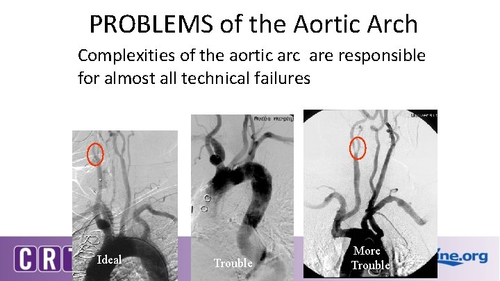 PROBLEMS of the Aortic Arch Complexities of the aortic are responsible for almost all