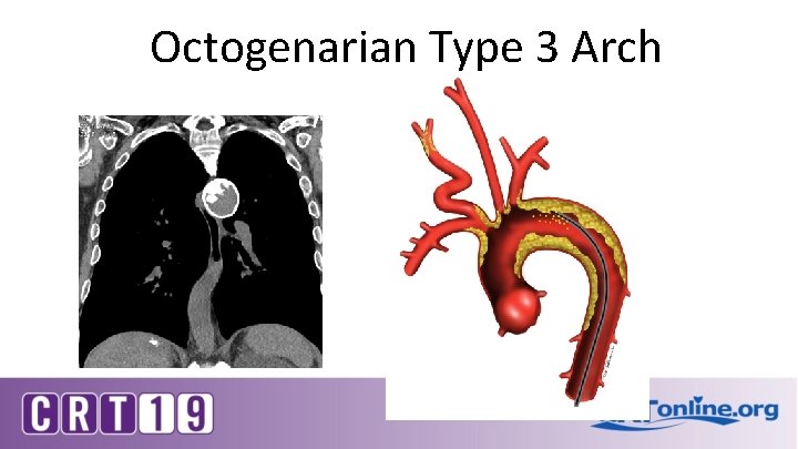 Octogenarian Type 3 Arch Embolic source vulnerable plaque 