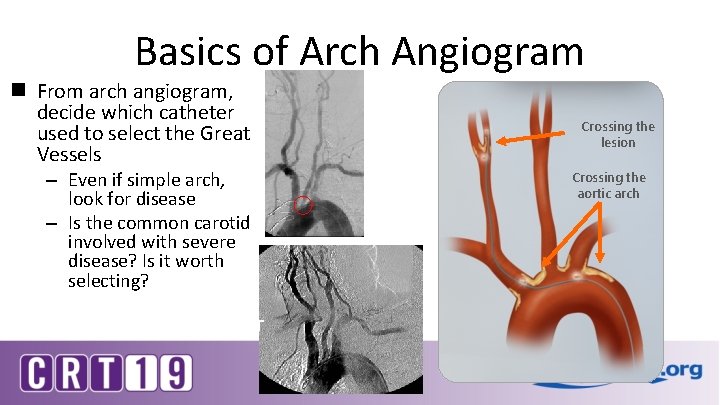 Basics of Arch Angiogram n From arch angiogram, decide which catheter used to select