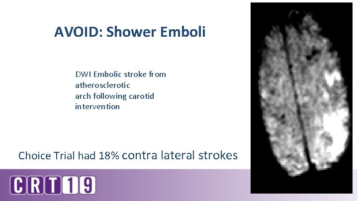 AVOID: Shower Emboli DWI Embolic stroke from atherosclerotic arch following carotid intervention Choice Trial