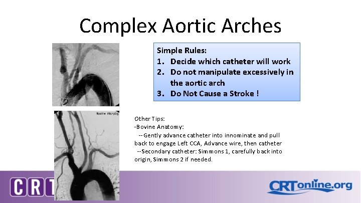 Complex Aortic Arches Simple Rules: 1. Decide which catheter will work 2. Do not