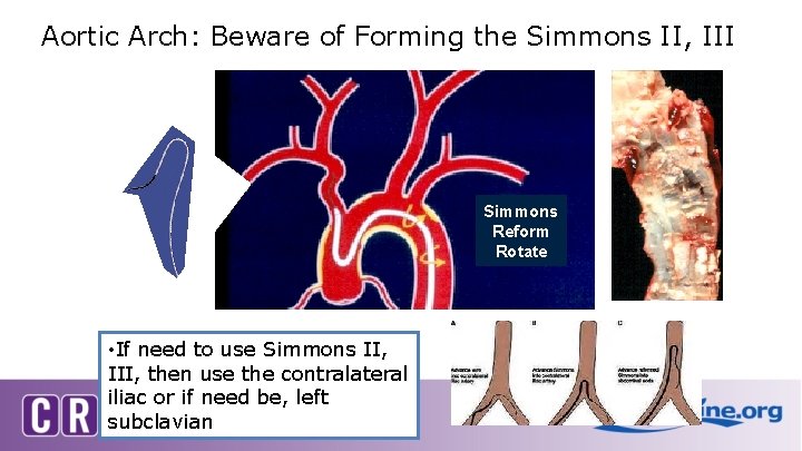 Aortic Arch: Beware of Forming the Simmons II, III Simmons Reform Rotate • If