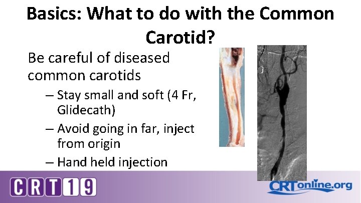 Basics: What to do with the Common Carotid? Be careful of diseased common carotids