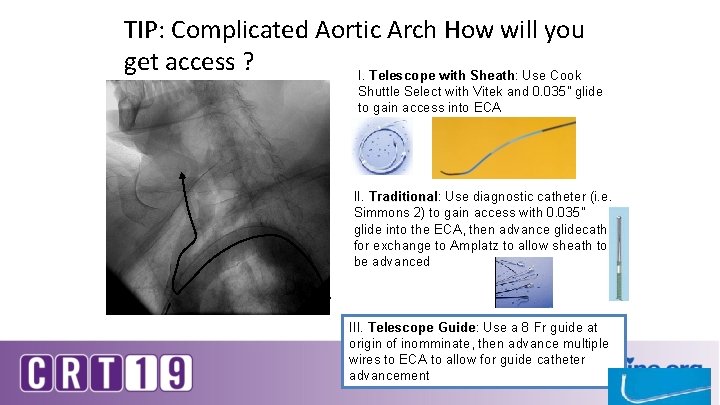TIP: Complicated Aortic Arch How will you get access ? I. Telescope with Sheath: