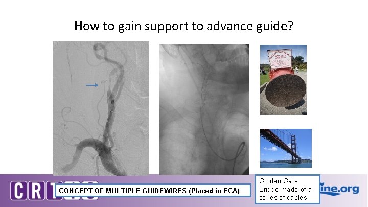 How to gain support to advance guide? CONCEPT OF MULTIPLE GUIDEWIRES (Placed in ECA)
