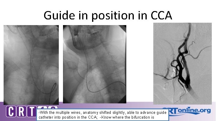 Guide in position in CCA -With the multiple wires, anatomy shifted slightly, able to
