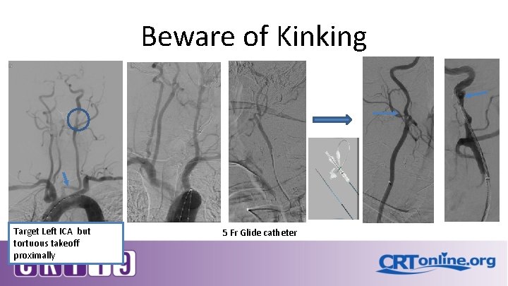 Beware of Kinking Target Left ICA but tortuous takeoff proximally 5 Fr Glide catheter