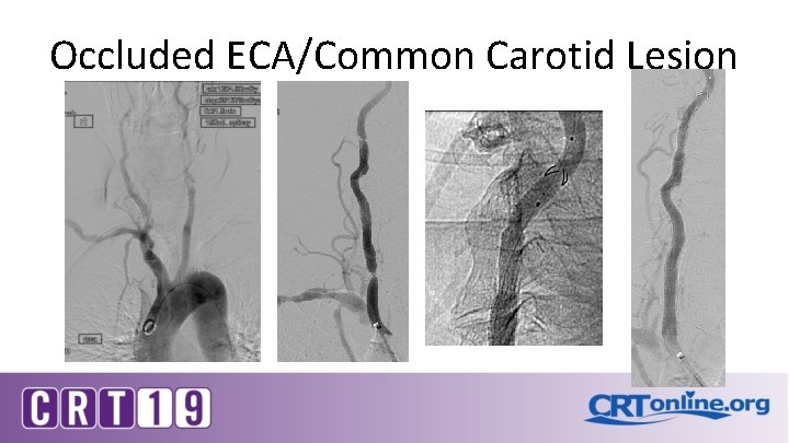 Occluded ECA/Common Carotid Lesion 