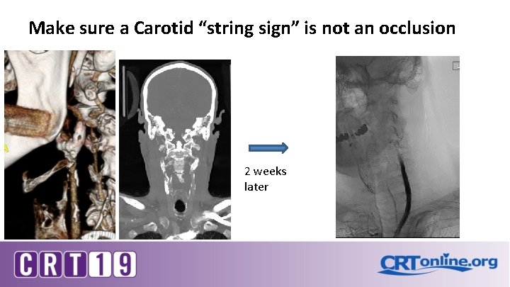 Make sure a Carotid “string sign” is not an occlusion 2 weeks later 