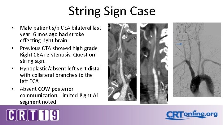 String Sign Case • • Male patient s/p CEA bilateral last year. 6 mos
