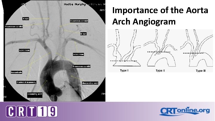 Importance of the Aorta Arch Angiogram 