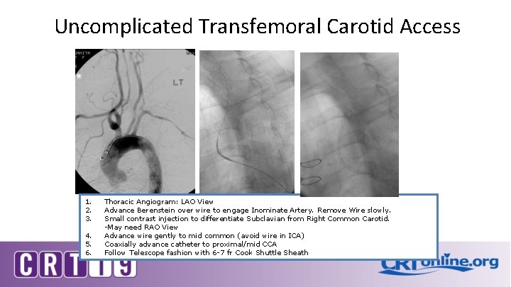 Uncomplicated Transfemoral Carotid Access 1. 2. 3. 4. 5. 6. Thoracic Angiogram: LAO View