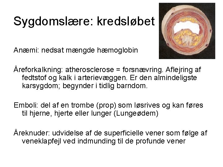 Sygdomslære: kredsløbet Anæmi: nedsat mængde hæmoglobin Åreforkalkning: atherosclerose = forsnævring. Aflejring af fedtstof og
