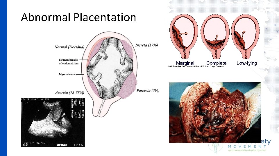 Abnormal Placentation • 