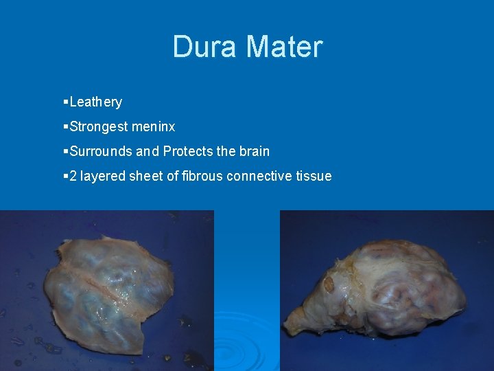 Dura Mater §Leathery §Strongest meninx §Surrounds and Protects the brain § 2 layered sheet