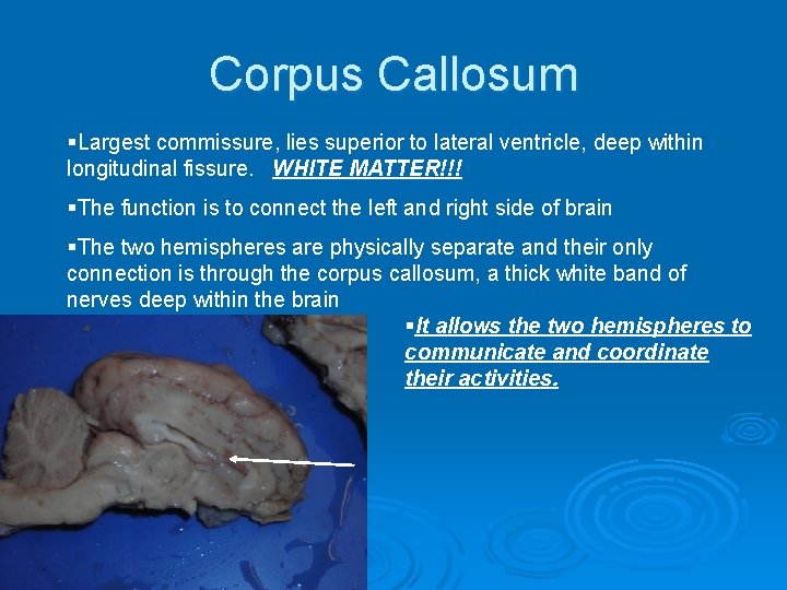 Corpus Callosum §Largest commissure, lies superior to lateral ventricle, deep within longitudinal fissure. WHITE