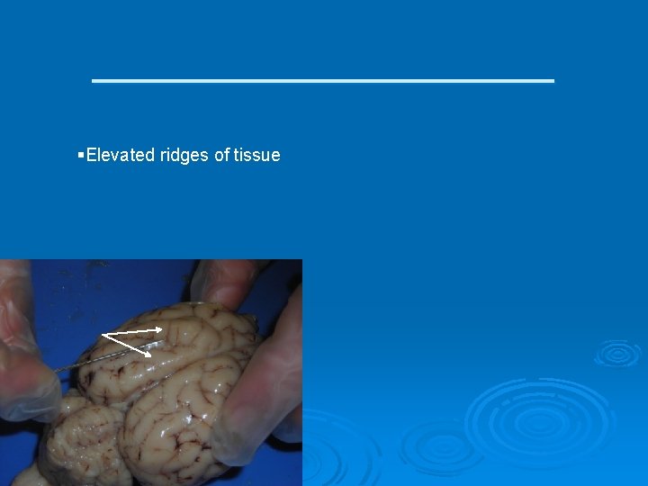 ___________ §Elevated ridges of tissue 