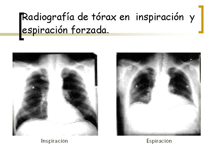 Radiografía de tórax en inspiración y espiración forzada. 