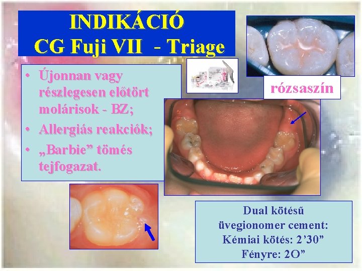 INDIKÁCIÓ CG Fuji VII - Triage • Újonnan vagy részlegesen előtört molárisok - BZ;