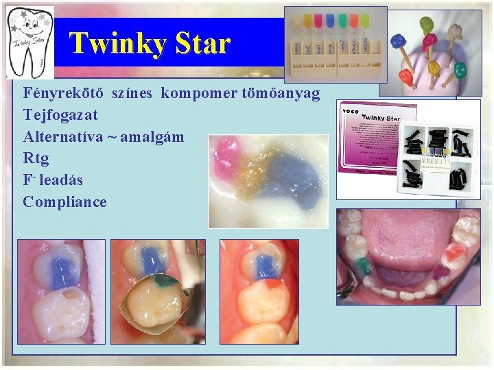 Twinky Star Fényrekötő színes kompomer tömőanyag Tejfogazat Alternatíva ~ amalgám Rtg F- leadás Compliance
