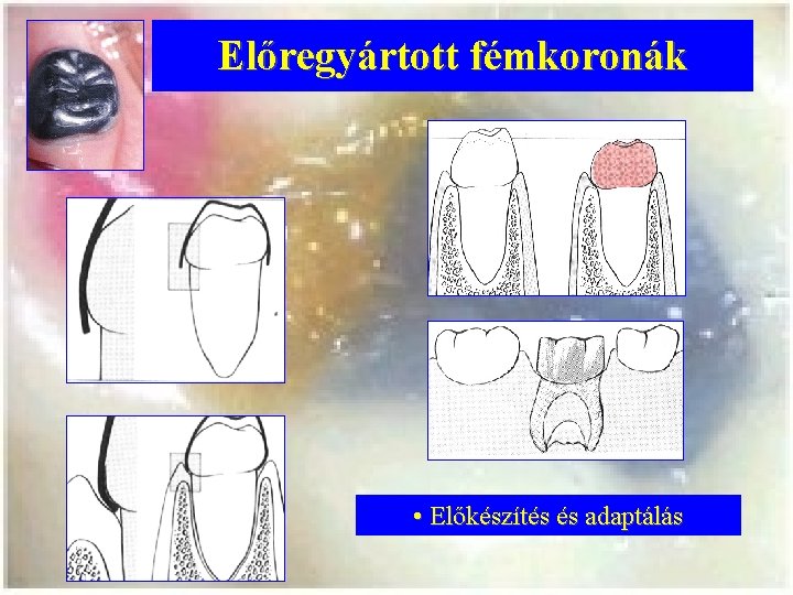 Előregyártott fémkoronák • Előkészítés és adaptálás 