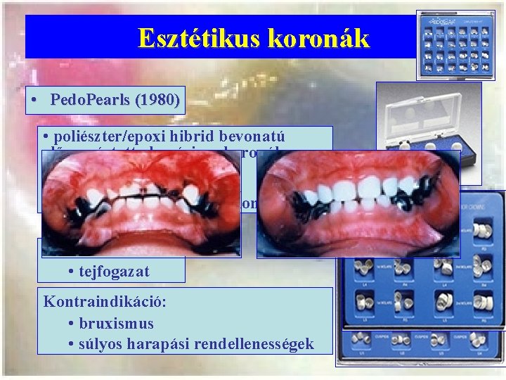 Esztétikus koronák • Pedo. Pearls (1980) • poliészter/epoxi hibrid bevonatú előregyártott alumínium koronák •