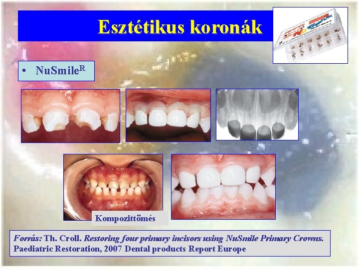 Esztétikus koronák • Nu. Smile. R Kompozittömés Forrás: Th. Croll. Restoring four primary incisors