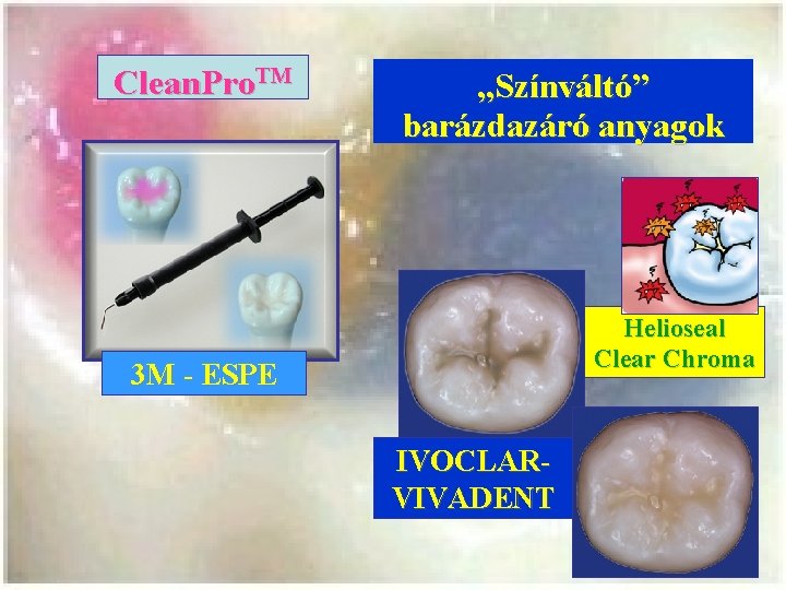 Clean. Pro. TM „Színváltó” barázdazáró anyagok Helioseal Clear Chroma 3 M - ESPE IVOCLARVIVADENT