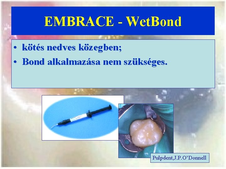 EMBRACE - Wet. Bond • kötés nedves közegben; • Bond alkalmazása nem szükséges. Pulpdent,