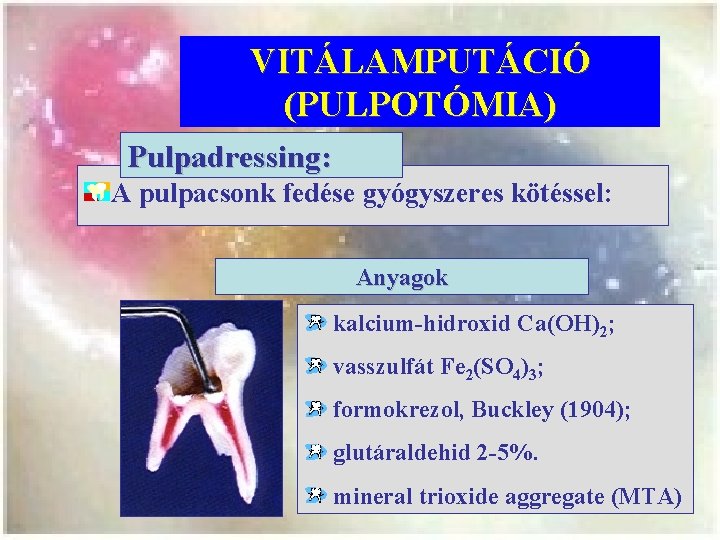 VITÁLAMPUTÁCIÓ (PULPOTÓMIA) Pulpadressing: A pulpacsonk fedése gyógyszeres kötéssel: Anyagok kalcium-hidroxid Ca(OH)2; vasszulfát Fe 2(SO