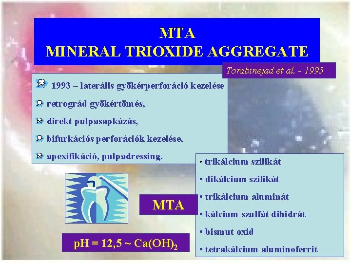 MTA MINERAL TRIOXIDE AGGREGATE Torabinejad et al. - 1995 1993 – laterális gyökérperforáció kezelése