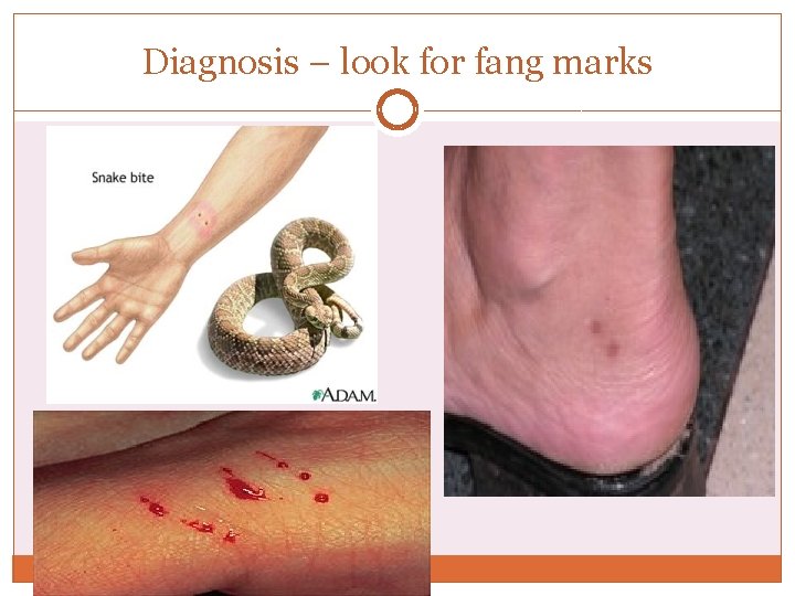 Diagnosis – look for fang marks Diagnosis – look for fang marks