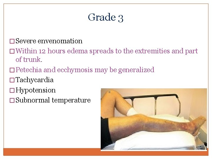 Grade 3 � Severe envenomation � Within 12 hours edema spreads to the extremities Grade 3 � Severe envenomation � Within 12 hours edema spreads to the extremities