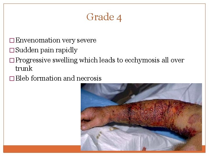 Grade 4 � Envenomation very severe � Sudden pain rapidly � Progressive swelling which Grade 4 � Envenomation very severe � Sudden pain rapidly � Progressive swelling which