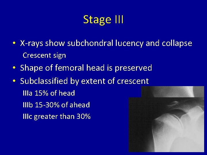 Stage III • X-rays show subchondral lucency and collapse Crescent sign • Shape of