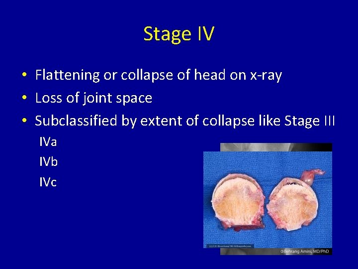 Stage IV • Flattening or collapse of head on x-ray • Loss of joint