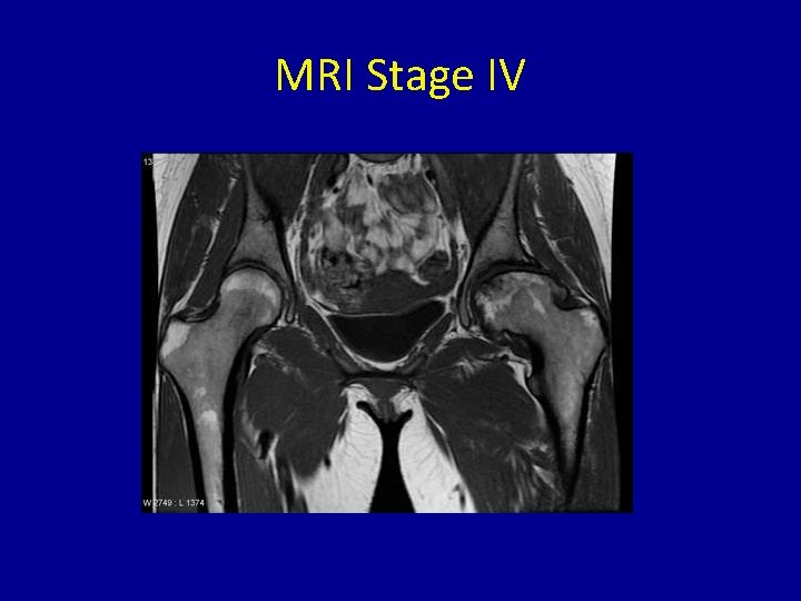 MRI Stage IV 